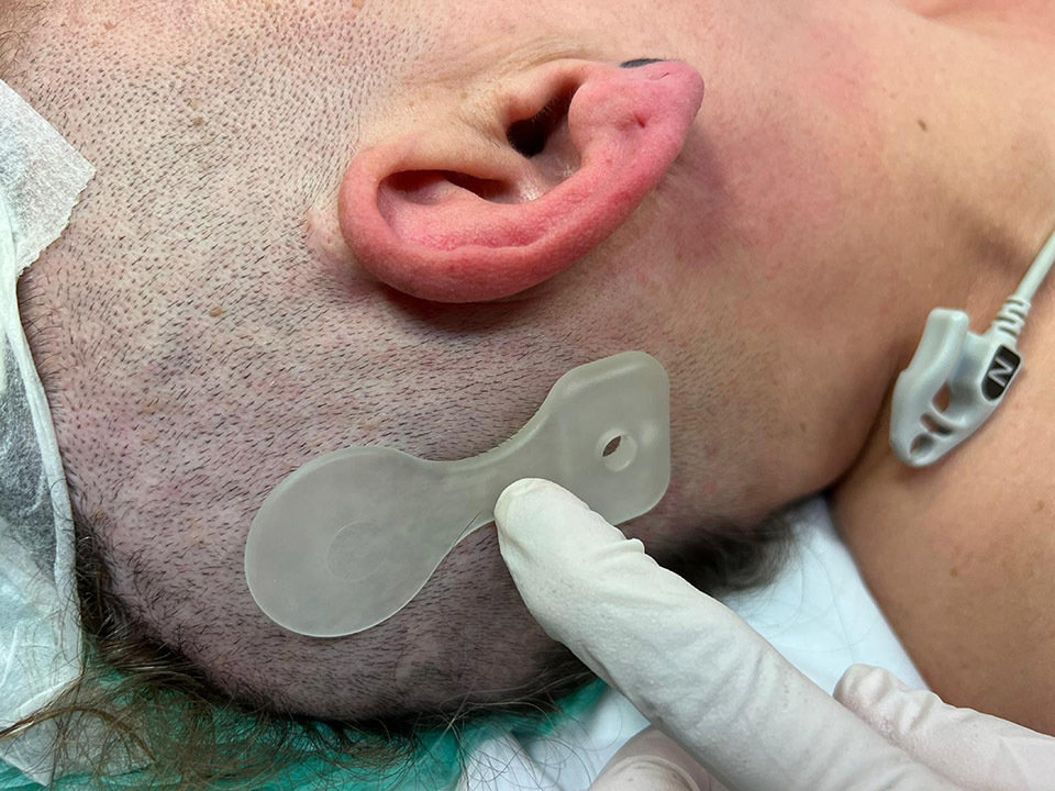 Implant que es col·loca per sota la pell per millorar l'audició de pacients amb pèrdues auditives - Foto cedida per l'ICS Lleida