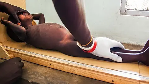 9 February 2016. Juba: A nurse measures Ojum Mai (2,5) at Al Sabbah Children Hospital in Juba, South Sudan. The child suffers a severe malnutrition and is going to receive a feeding program at the health centre. 
South Sudan is facing unprecedented levels of food insecurity, as 2.8 million people – nearly 25 percent of the country’s population – remain in urgent need of food assistance, and at least 40,000 people are on the brink of catastrophe, three UN agencies warned.
The Food and Agriculture Organization of the United Nations (FAO), the United Nations Children’s Fund (UNICEF) and the World Food Programme (WFP) stressed that these numbers are particularly worrisome because they show an increase in hunger during the post-harvest period – a time when the country is traditionally most food secure.
The number of food insecure people is expected to peak during the coming lean season – traditionally worst between April and July – when food availability is lowest.  Humanitarian partners have released an update to the Integrated Food Security Phase Classification (IPC) analysis, which projects that the lean season will start early this year, and the hunger period will be longer than in previous years.  
PHOTO UNICEF / ALBERT GONZALEZ FARRAN