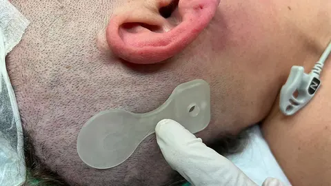 Implant que es col·loca per sota la pell per millorar l'audició de pacients amb pèrdues auditives - Foto cedida per l'ICS Lleida